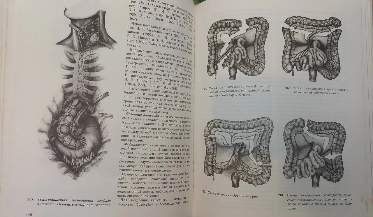 Атлас операцій на стравоході, шлунку і дванадцятипалої кишці. О.О.Шалімов.1975 фото 5